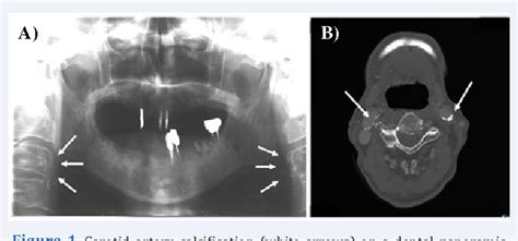 Figure 1 From Association Of Carotid Artery Calcification Detected On