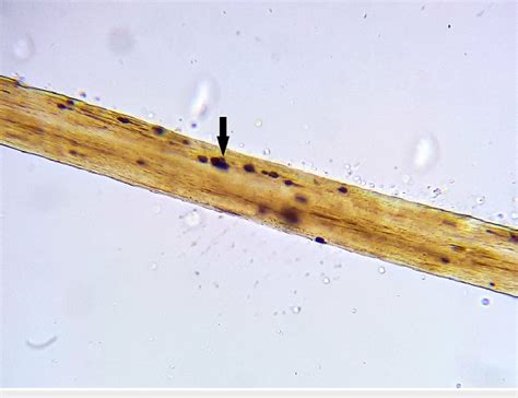 Microscopic examination of a hair shaft showing an abnormal ...