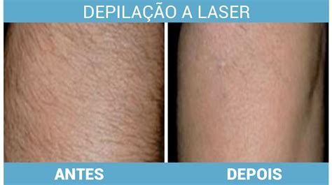 Valor Da Depilação A Laser Em 2024