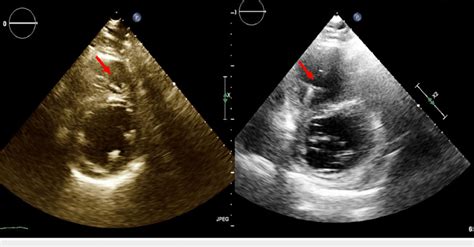 Transthoracic Echocardiogram Before Left And After AAA Repair