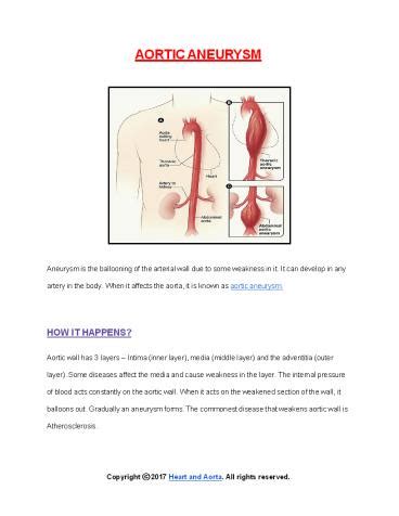 PPT Diseases Of Aorta Aortic Aneurysm PowerPoint Presentation