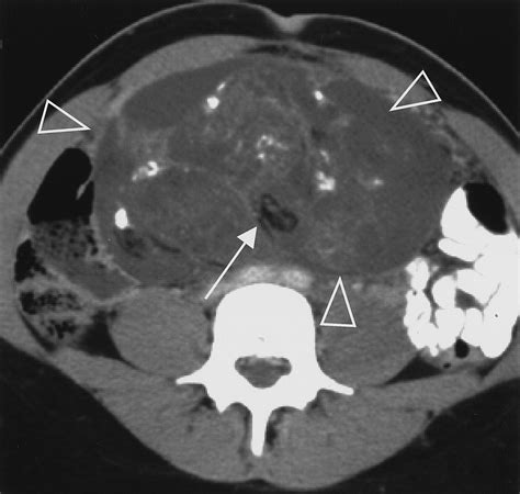 Ovarian Teratomas Tumor Types And Imaging Characteristics RadioGraphics