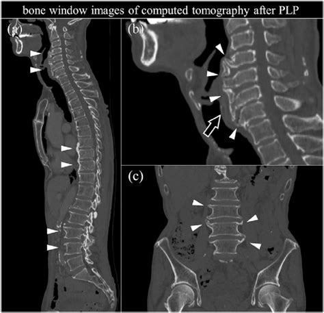 Bone Window Images Of Computed Tomography After Plp A Sagittal View