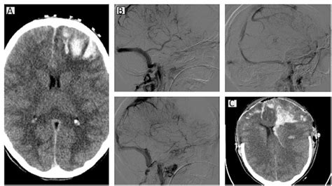 Computed tomography (CT) scans for case 2. A brain CT scan showed... | Download Scientific Diagram