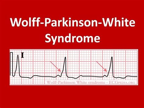 Ecg Wolff Parkinson White Syndrome