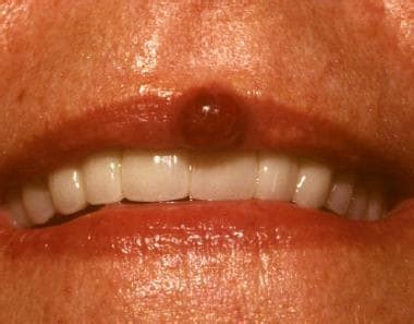 Pyogenic Granuloma Lip