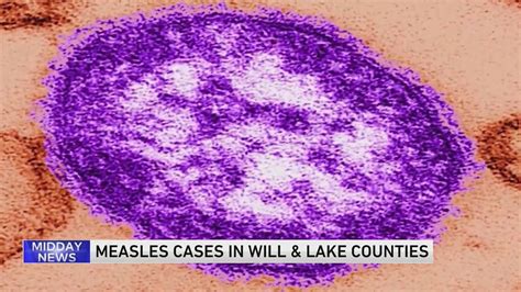 Will County Reports Positive Case Of Measles Connected To Chicago