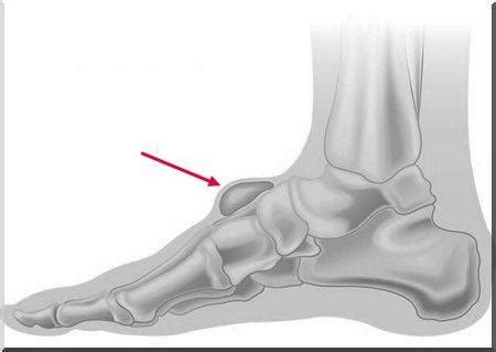 Comment Soigner Un Kyste Naturellement Synovial GoMedica