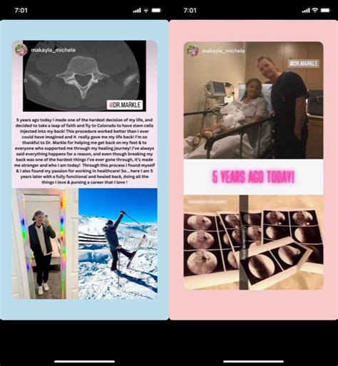 Helping a Competitive Teen Gymnast with Spondylolysis Avoid Surgery