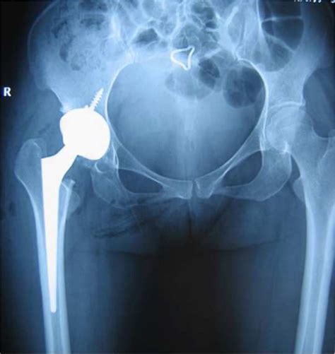 Immediate Postoperative Anteroposterior Radiographs Demonstrating