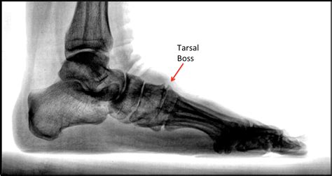 Metatarsal Bone Spur Treatment