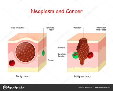 Cancer Tumeur Comparaison Différence Entre Tumeur Maligne Bénigne