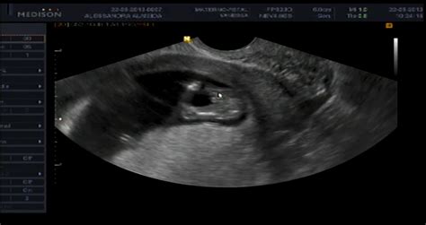 Ultrassom Bebe 3 Meses - Imagens De Ultrassom De 3 Meses