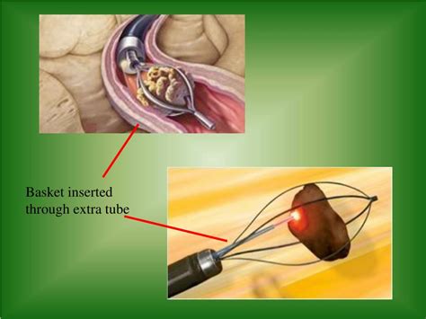 Ppt Cystoscopy And Ureteroscopy Powerpoint Presentation Free Download Id3254641