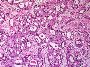 Invasive cribriform carcinoma of the breast - Libre Pathology