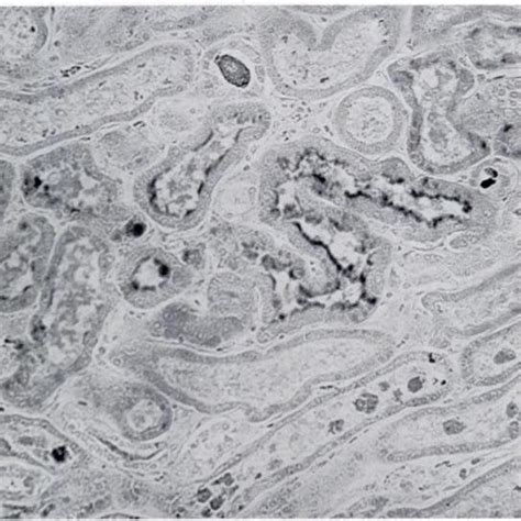 -Photomicrograph of kidney showing hemosiderin deposition within the ...