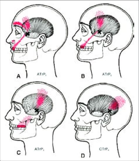 Abcd Patterns Of Referred Pain And Tenderness From Various Trigger