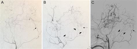 Occipital Artery To Middle Cerebral Artery Bypass In Pediatric Moyamoya