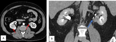 Ct Scan Showing A Bilateral Small Renal Masses In Axial Section S