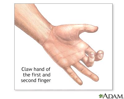 Claw hand - UF Health