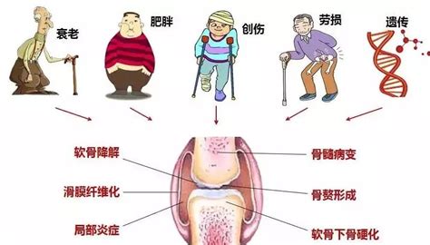 健康科普 且行且珍膝——膝关节炎科普 知乎