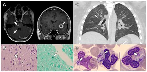 Frontiers Case Report Immune Dysregulation Due To Toxoplasma Gondii Reactivation After