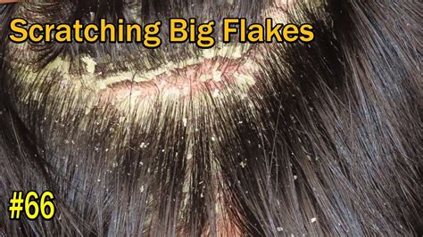 Scratching Huge Dandruff Flakes Never End Dandruff Removal Satisfying