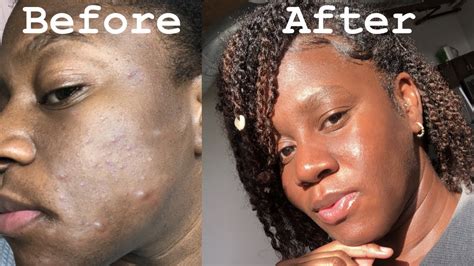 How To Get Rid Of Acne Scars And Dark Spots Naturally Natural