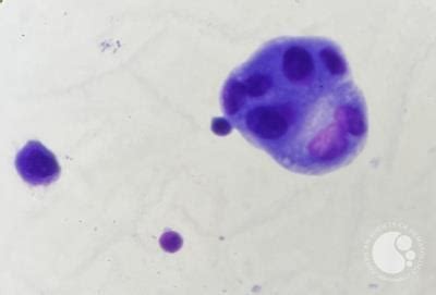 Lung cancer metastasis to pleural fluid