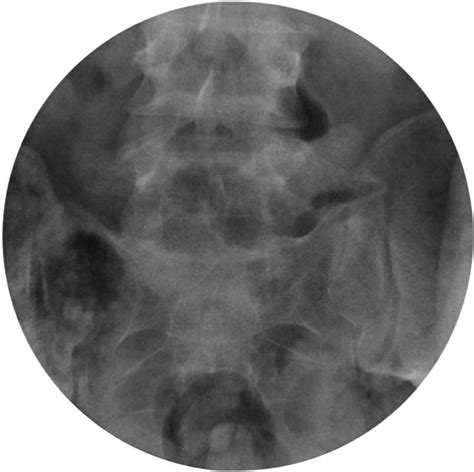 Anteroposterior Lower Lumbar Spine Intraoperative Radiograph