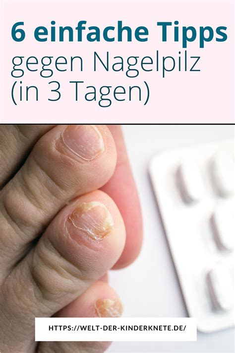 Erwiesen So Kannst Du Nagelpilz Wirklich Loswerden Nagelpilz