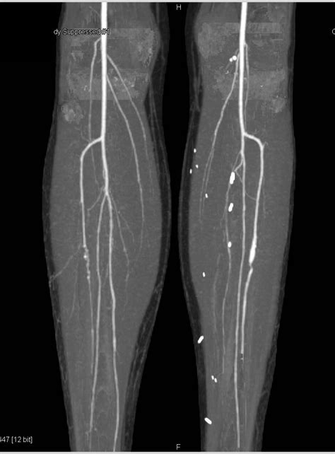 Aneurysm Of Superior Mesenteric Artery SMA And Left Anterior Tibial