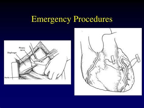 Ppt Common Thoracic Procedures Powerpoint Presentation Id520658