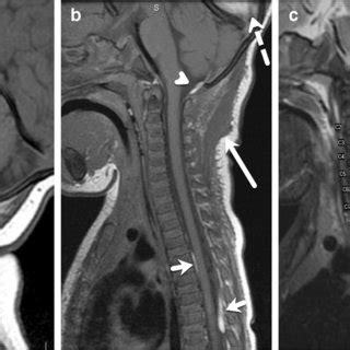 Capsular Injury In A Month Old Boy With Abusive Head Trauma A