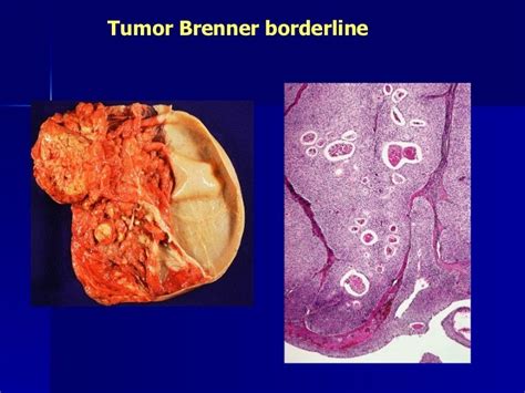 Tumor Borderline De Ovario Pdf