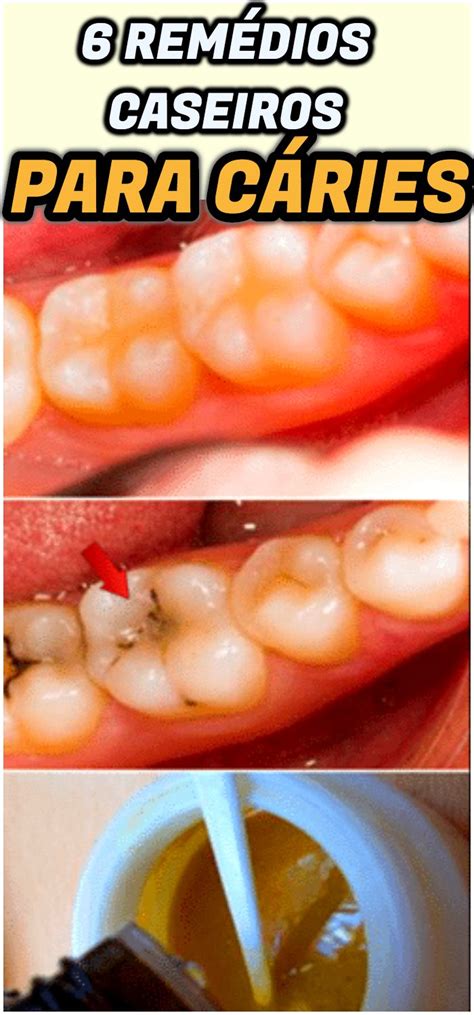 Os Remédios Caseiros Para Curar Cáries Naturalmente Com Ingredientes E