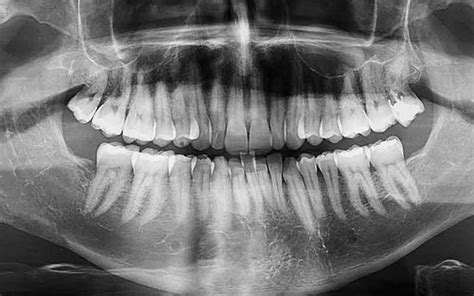 Facts About Metal Fillings - SmileHaven Dental Center