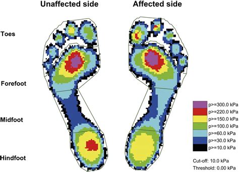 Discrepancies In Plantar Pressure Distribution Between Affected And