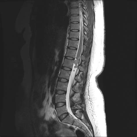 Intradural Extramedullary Schwannoma Image Radiopaedia Org