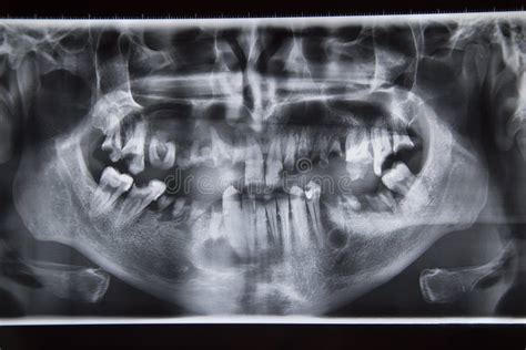 Dental Xray With Bad Teeth Stock Image Image Of Head 52812955