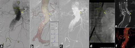 Computed Tomography Angiography Fluoroscopy Image Fusion Allows