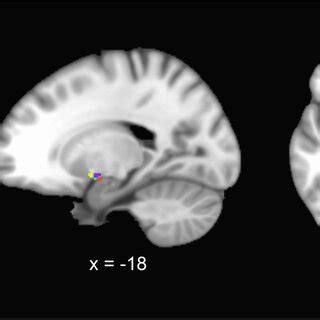 Structural covariance network of the basal forebrain and right... | Download Scientific Diagram