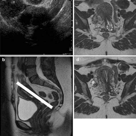 Pdf Esur Guidelines For Mr Imaging Of The Sonographically Indeterminate Adnexal Mass An