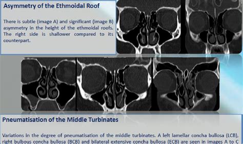 Figure 5 From Functional Endoscopic Sinus Surgery Fess What