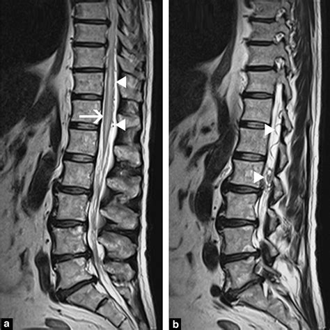 T Weighted Spinal Cord Mri Centered On The Lumbosacral Region