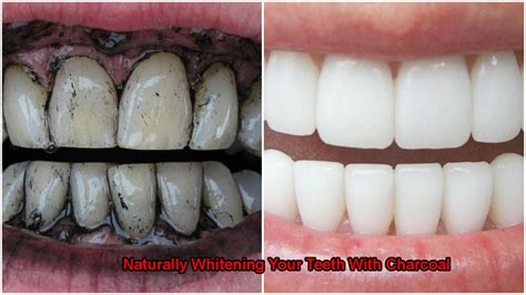 Naturally Whitening Your Teeth With Charcoal