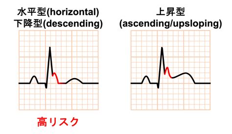 早期再分極症候群とは? | 心電図.com