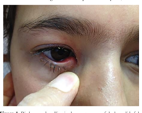 Figure 1 From Pediatric Canaliculitis A Case Report Semantic Scholar