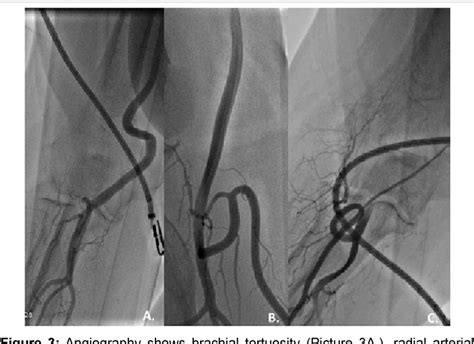 Figure 1 From Radial Artery Cannulation A Systemic Review Semantic Scholar