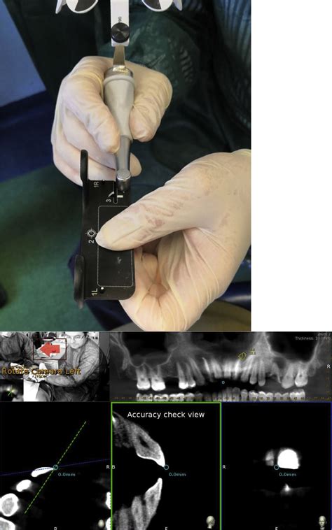 Endodontic Microsurgery Using Dynamic Navigation System A Case Report Journal Of Endodontics